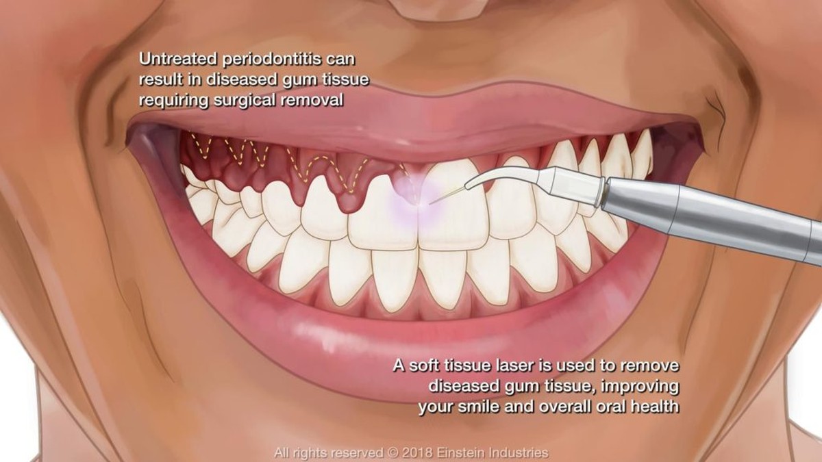 Kaugummi auf dem Teppich? Das einzige Mittel, das funktioniert - image 1